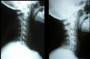 Rectificación Cervical-Osteopatia Lanziano